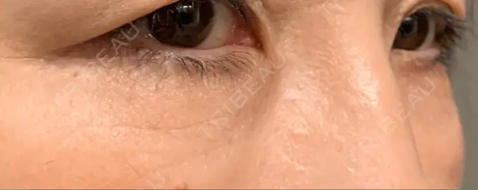 クマ治療 / 下まぶたたるみ取り / 脂肪注入（肌） 湘南美容クリニック 藤沢院 DAY 63 メイン用