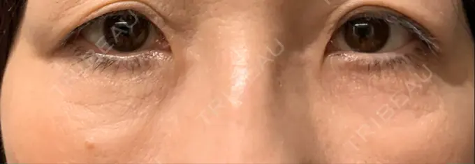 クマ治療 / 下まぶたたるみ取り / 脂肪注入（肌） 湘南美容クリニック 藤沢院 AFTER メイン用