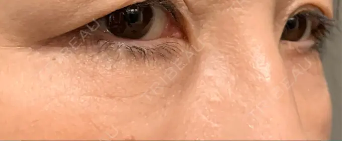 クマ治療 / 下まぶたたるみ取り / 脂肪注入（肌） 湘南美容クリニック 藤沢院 DAY 63 メイン用