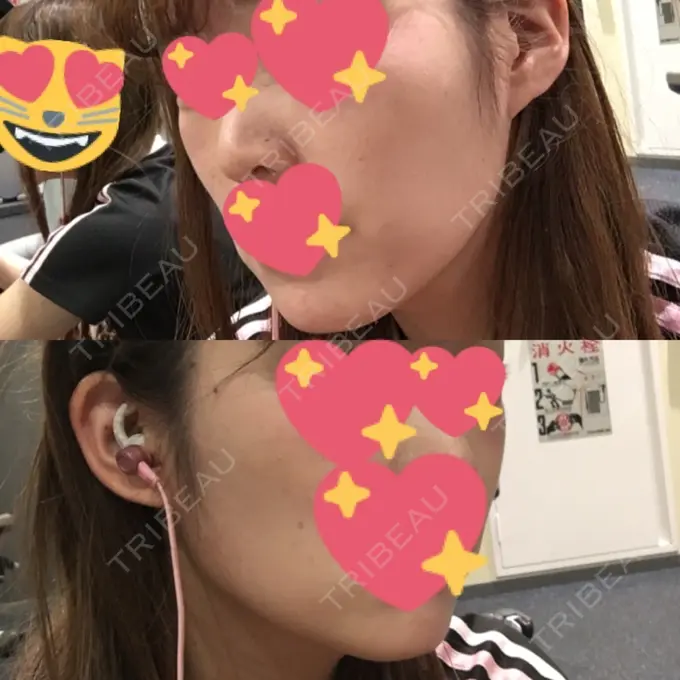 バッカルファット除去 / ボトックス（エラ・小顔） 湘南美容クリニック 秋葉原院 DAY 61 メイン用