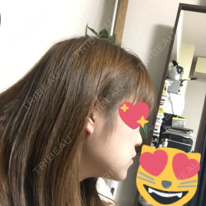 バッカルファット除去 / ボトックス（エラ・小顔） 湘南美容クリニック 秋葉原院 DAY 16 メイン用