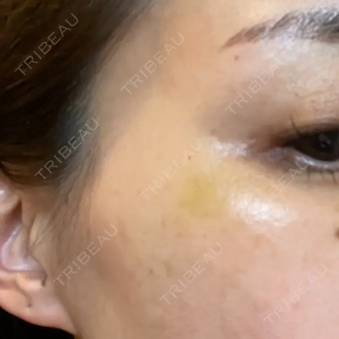 ボトックス（目尻） 湘南美容クリニック 岡山院 DAY 5 メイン用