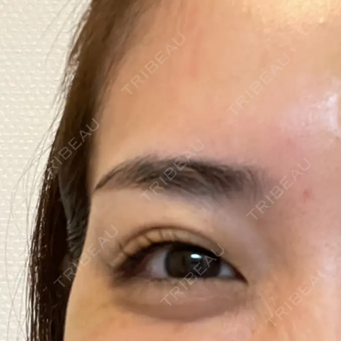 ボトックス（目尻） 湘南美容クリニック 岡山院 DAY 6 メイン用