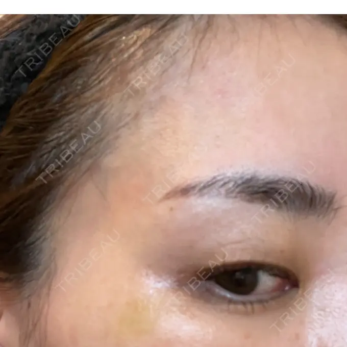 ボトックス（目尻） 湘南美容クリニック 岡山院 DAY 7 メイン用