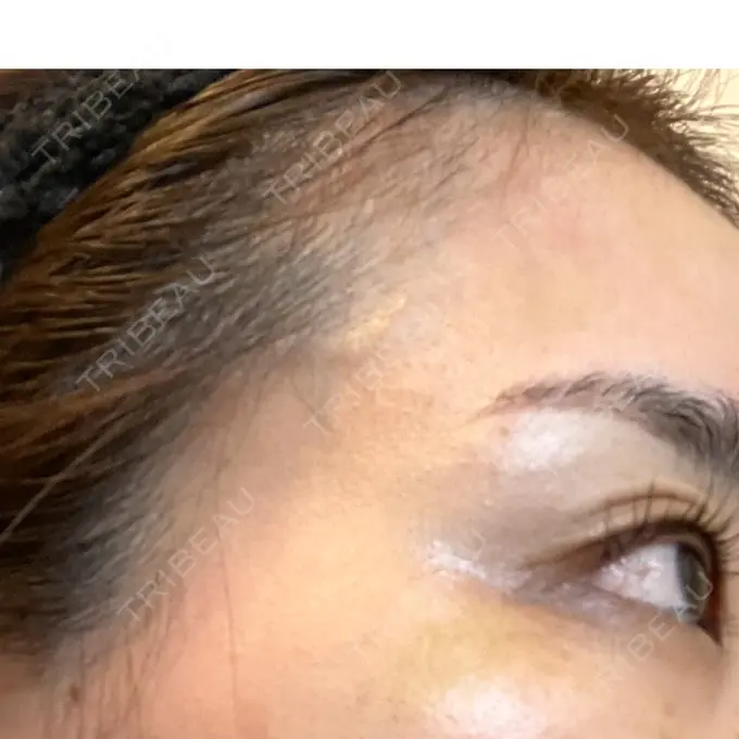 ボトックス（目尻） 湘南美容クリニック 岡山院 DAY 8 メイン用