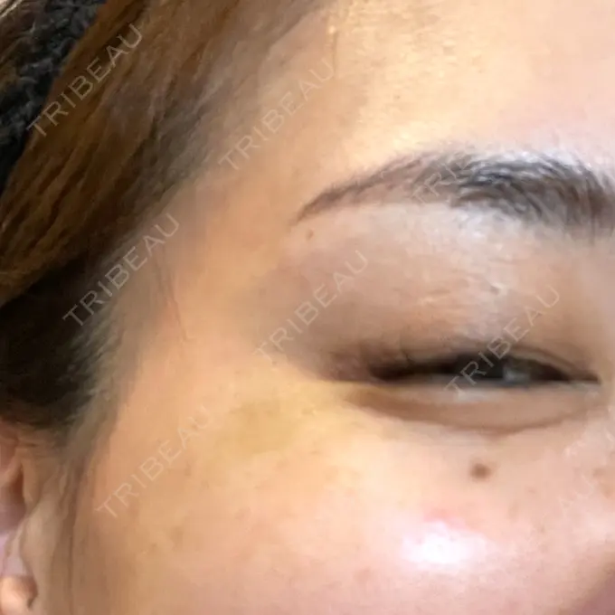 ボトックス（目尻） 湘南美容クリニック 岡山院 DAY 9 メイン用