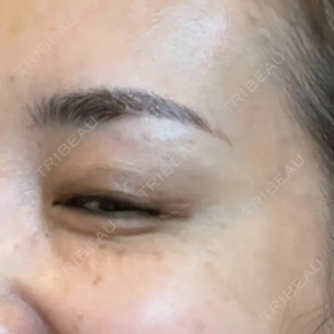 ボトックス（目尻） 湘南美容クリニック 岡山院 DAY 9 メイン用