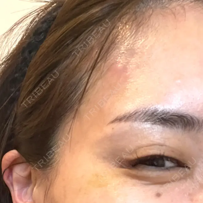 ボトックス（目尻） 湘南美容クリニック 岡山院 AFTER メイン用