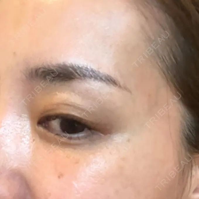 ボトックス（目尻） 湘南美容クリニック 岡山院 DAY 10 メイン用