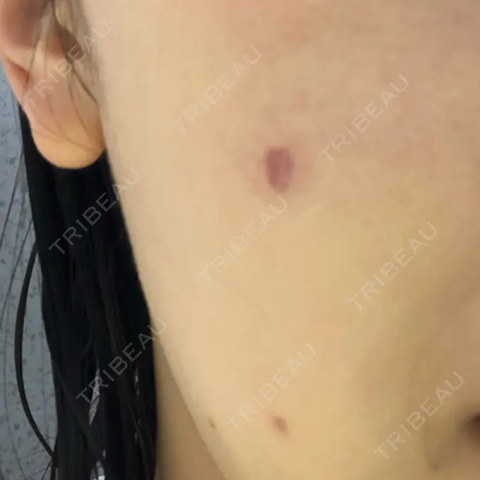 ほくろ・いぼ切除（肌） 吉祥寺アイビークリニック DAY 18 メイン用