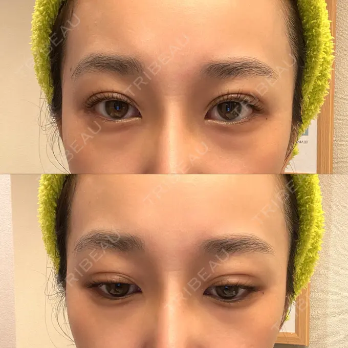 二重埋没 横浜TAクリニック DAY 20 メイン用