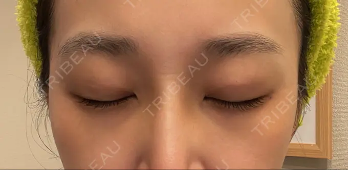 二重埋没 横浜TAクリニック DAY 20 メイン用