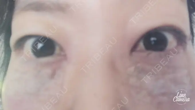 下まぶたの脂肪取り 吉井クリニック DAY 2 メイン用