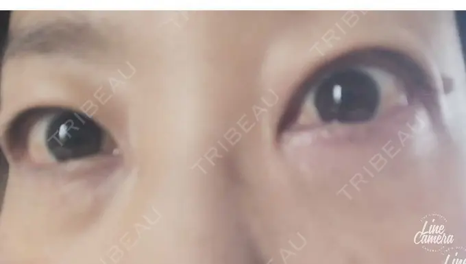 下まぶたの脂肪取り 吉井クリニック DAY 3 メイン用