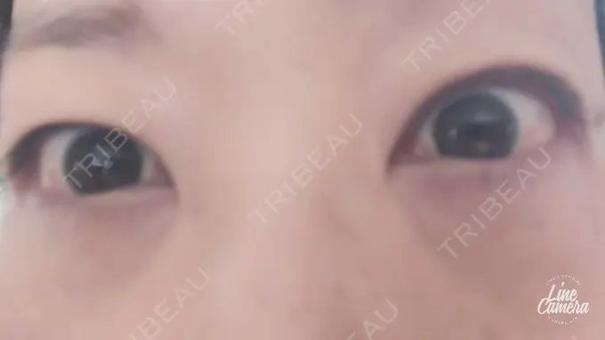 下まぶたの脂肪取り 吉井クリニック DAY 4 メイン用