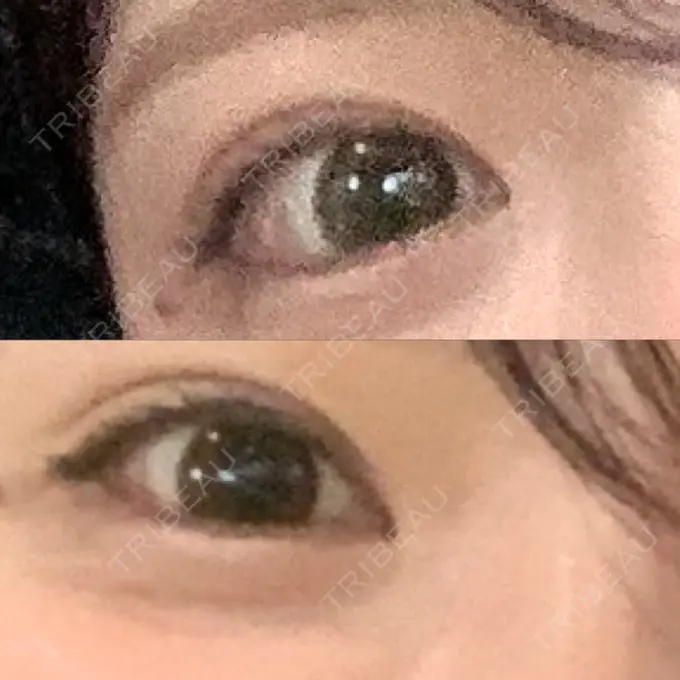 二重埋没 十仁美容整形 AFTER メイン用