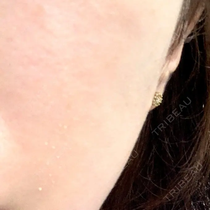 ヒアルロン酸注入（頬） 十仁美容整形 DAY 1 メイン用