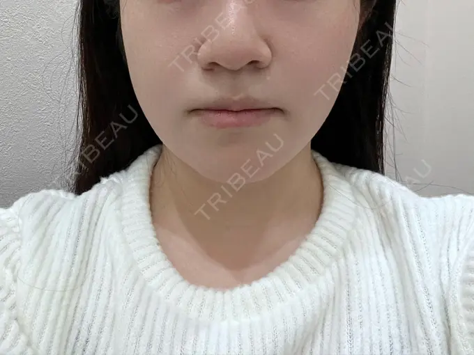 脂肪吸引（顔） THE CLINIC（ザ・クリニック） 福岡院 AFTER メイン用