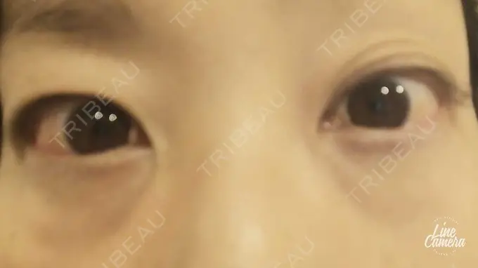 下まぶたの脂肪取り 吉井クリニック DAY 6 メイン用