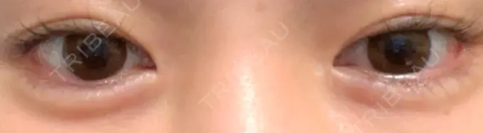 ヒアルロン酸注入（涙袋） 渋谷美容外科クリニック 渋谷院 DAY 14 メイン用