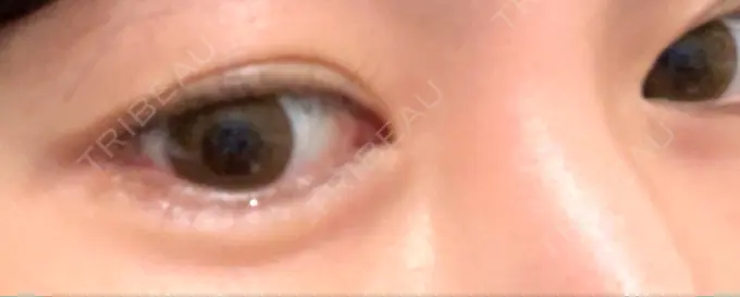 ヒアルロン酸注入（涙袋） 渋谷美容外科クリニック 渋谷院 DAY 15 メイン用