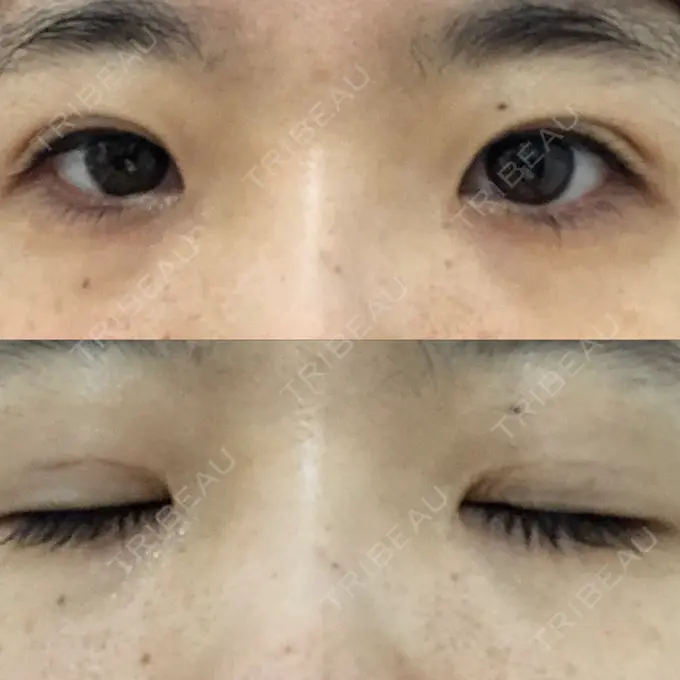 二重埋没 / 眼瞼下垂（非切開） WOM CLINIC GINZA （ワム クリニック ギンザ） DAY 30 メイン用