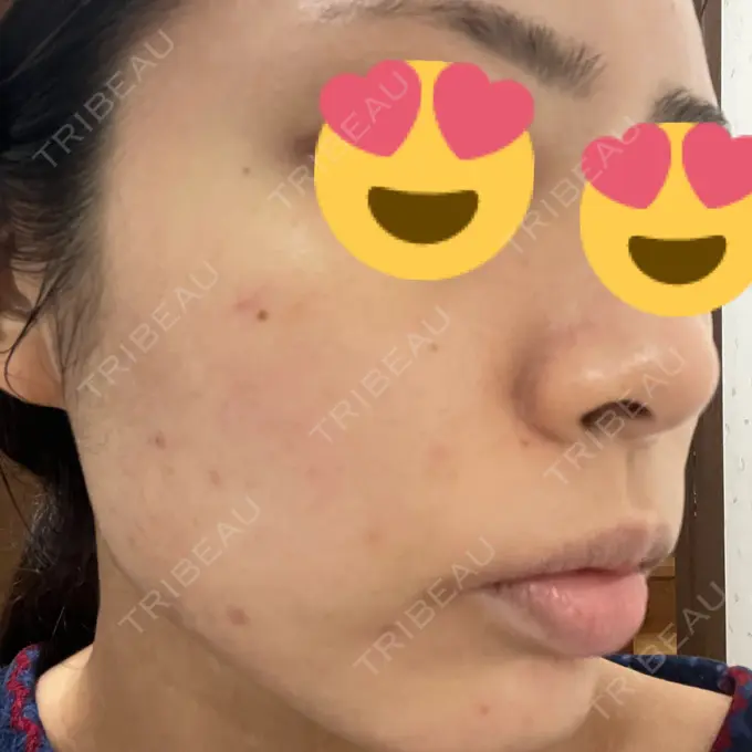 ヴェルヴェットスキン ジョウクリニック 松山院 AFTER メイン用