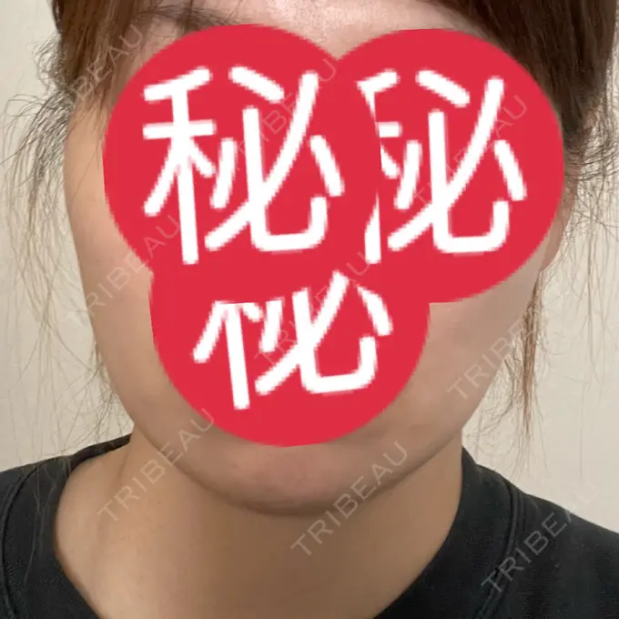 医療痩身（顔） / その他（輪郭） WOM CLINIC GINZA （ワム クリニック ギンザ） DAY 166 メイン用