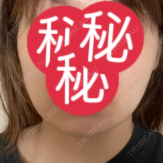 医療痩身（顔） / その他（輪郭） WOM CLINIC GINZA （ワム クリニック ギンザ） DAY 172 メイン用