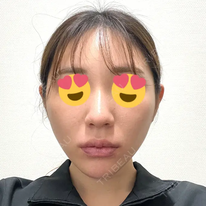 糸リフト / バッカルファット除去 大阪TAクリニック AFTER メイン用