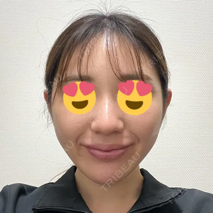 糸リフト / バッカルファット除去 大阪TAクリニック DAY 31 メイン用