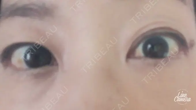 下まぶたの脂肪取り 吉井クリニック DAY 8 メイン用