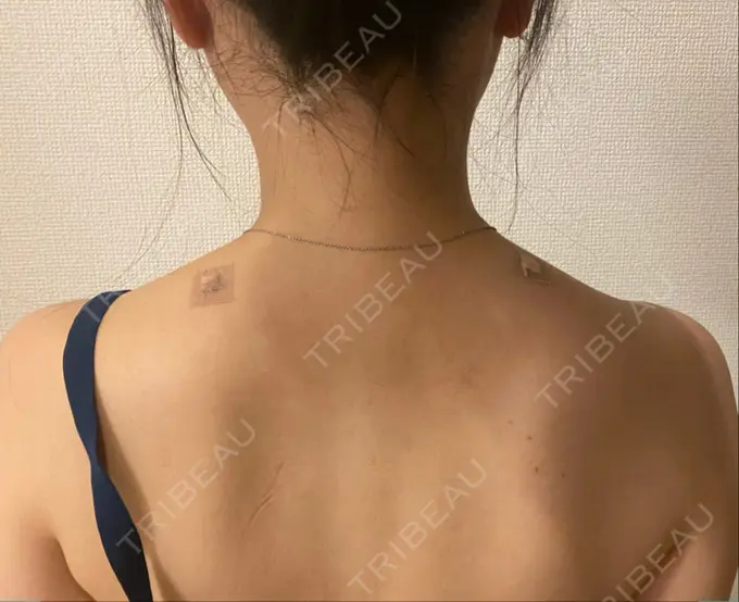 ボトックス（肩） 赤坂プレミアクリニック DAY 1 メイン用