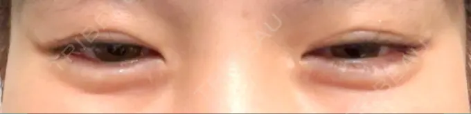 ヒアルロン酸注入（涙袋） 渋谷美容外科クリニック 渋谷院 AFTER メイン用