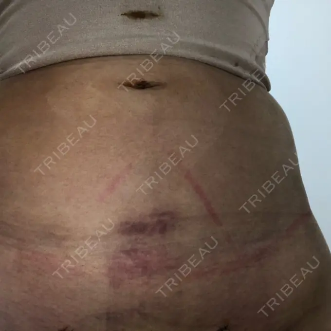 脂肪吸引（お腹） ドクターフィット（Dr.fit）クリニック DAY 1 メイン用