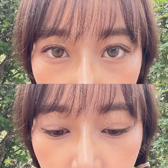 二重埋没 横浜TAクリニック AFTER メイン用