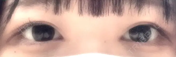 目頭切開 くさのたろうクリニック DAY 72 メイン用