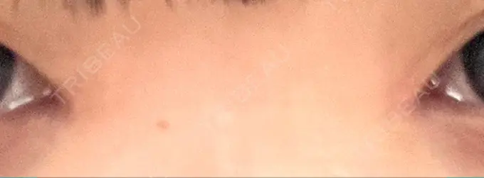 目頭切開 くさのたろうクリニック DAY 72 メイン用