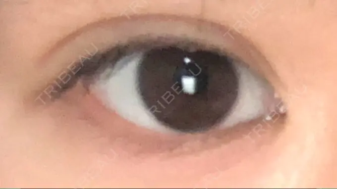 二重埋没 ラミュー広島中央クリニック DAY 29 メイン用