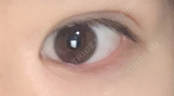 二重埋没 ラミュー広島中央クリニック DAY 29 メイン用