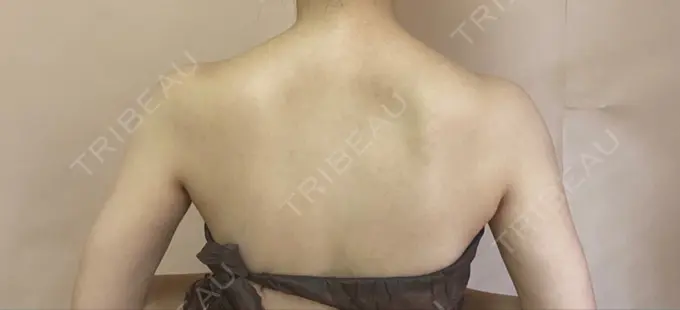 ボトックス（肩） 赤坂プレミアクリニック AFTER メイン用