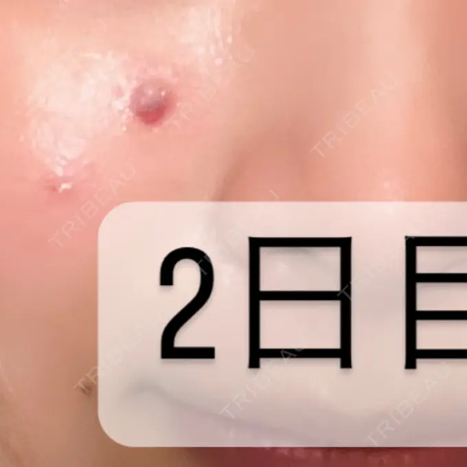 ほくろ・いぼ切除（肌） 吉祥寺アイビークリニック DAY 2 メイン用