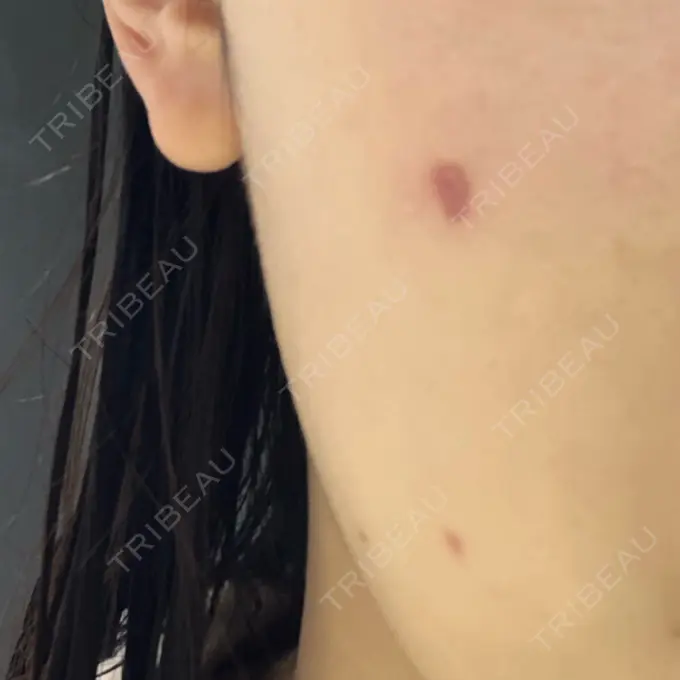 ほくろ・いぼ切除（肌） 吉祥寺アイビークリニック DAY 28 メイン用