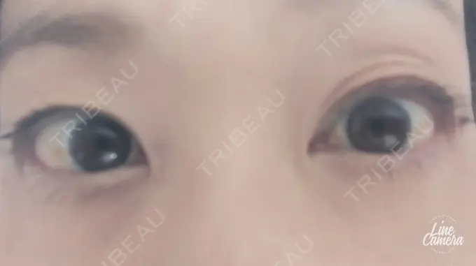 下まぶたの脂肪取り 吉井クリニック AFTER メイン用