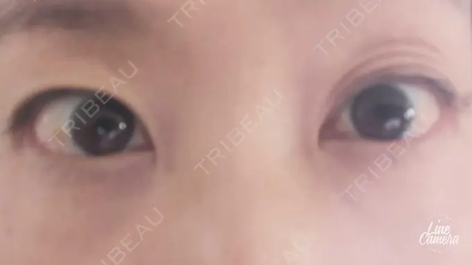 下まぶたの脂肪取り 吉井クリニック DAY 10 メイン用