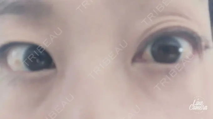 下まぶたの脂肪取り 吉井クリニック DAY 9 メイン用