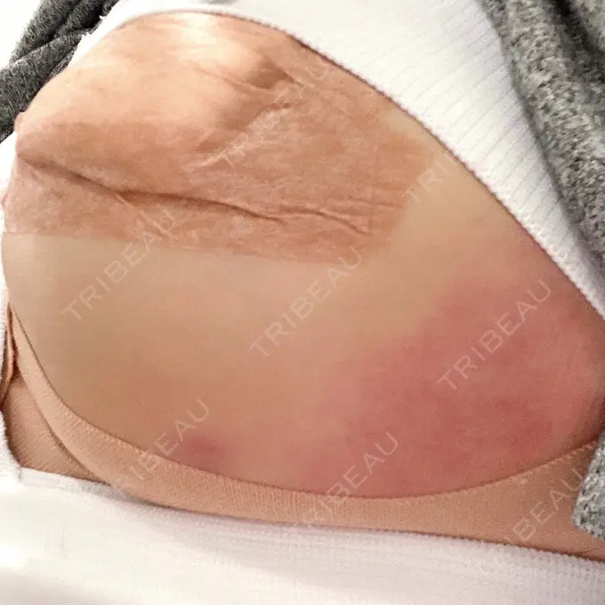 豊胸（シリコンバッグ） / 乳頭縮小 ジョウクリニック 大阪院 DAY 1 メイン用