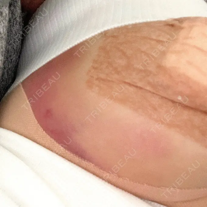 豊胸（シリコンバッグ） / 乳頭縮小 ジョウクリニック 大阪院 DAY 1 メイン用