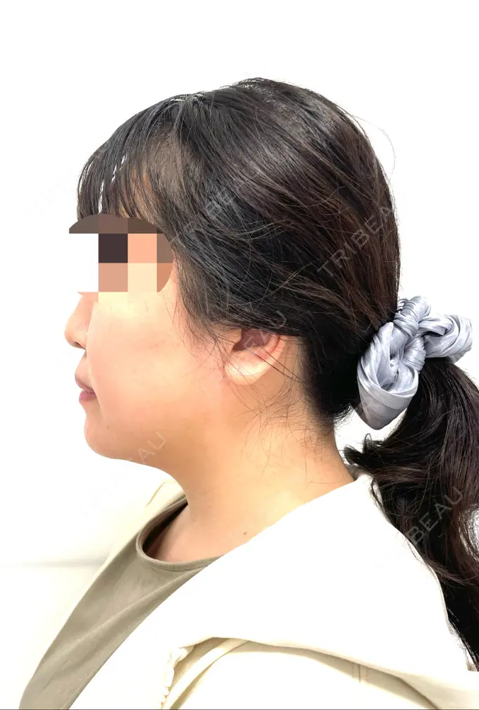 骨切り（あご） / セットバック カトレア歯科・美容クリニック DAY 92 メイン用