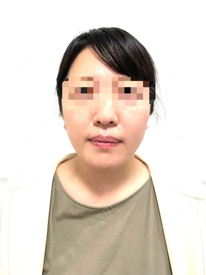 骨切り（あご） / セットバック カトレア歯科・美容クリニック DAY 92 メイン用